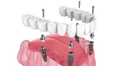 Illustration of an implant denture