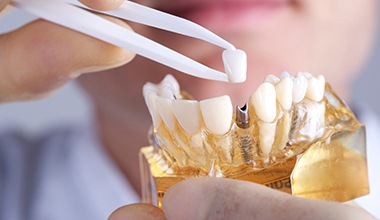 dentist placing a crown onto a dental implant model 