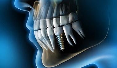 X-ray of a person with a single dental implant 
