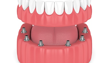 Model of implant-supported denture