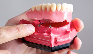 Lower plate of implant-supported dentures