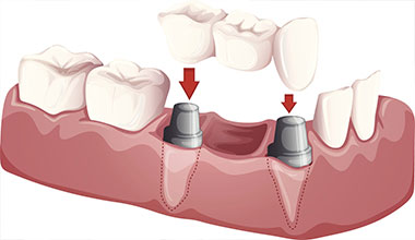 Worthington dental implant supported crown and bridge