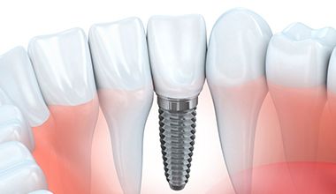 Diagram of an integrated dental implant in Worthington.