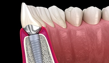 Diagram of an integrated dental implant in Worthington.