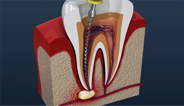 root canal procedure