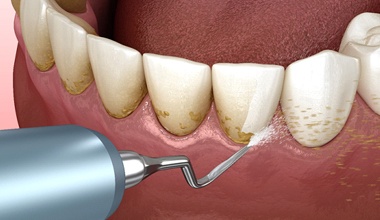 Scaling instrument removing plaque and tartar from teeth