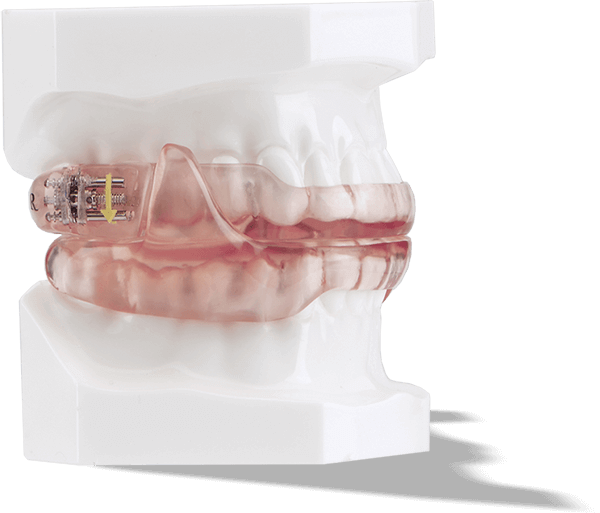 Oral appliance for sleep apnea therapy