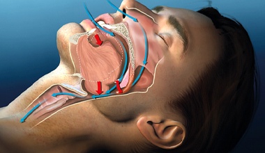 computer illustration of a person suffering from obstructive sleep apnea in Worthington