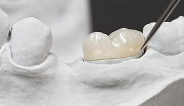 Worthington restorative dentistry dental crown & bridge placement