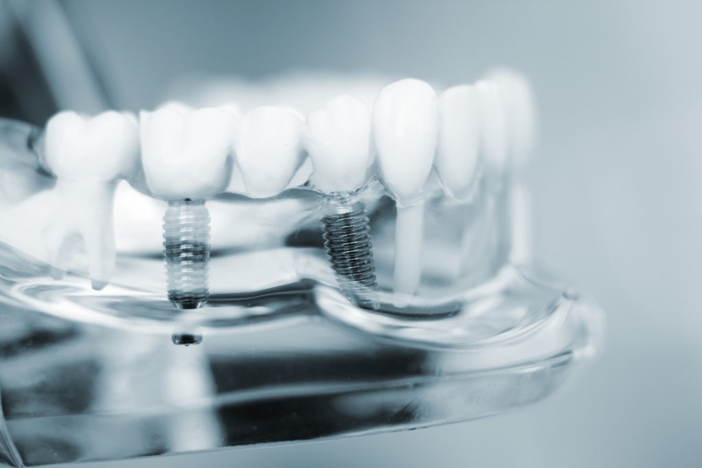 Model of modern dental implants